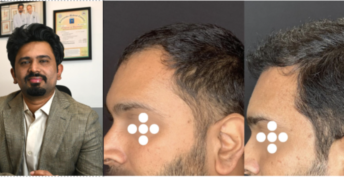 Hair Transplant Safety in India: Expert-Led Solutions at HAIRever